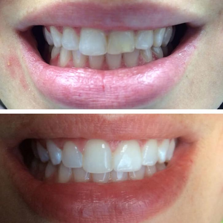 before and after photos of teeth that were chipped and are now repaired