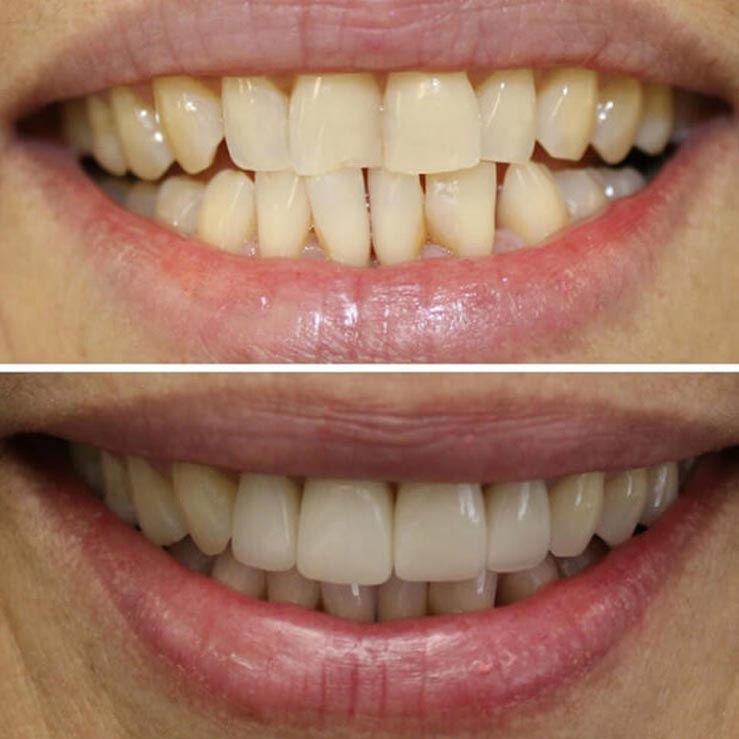 before and after photos of crooked teeth that are now straight