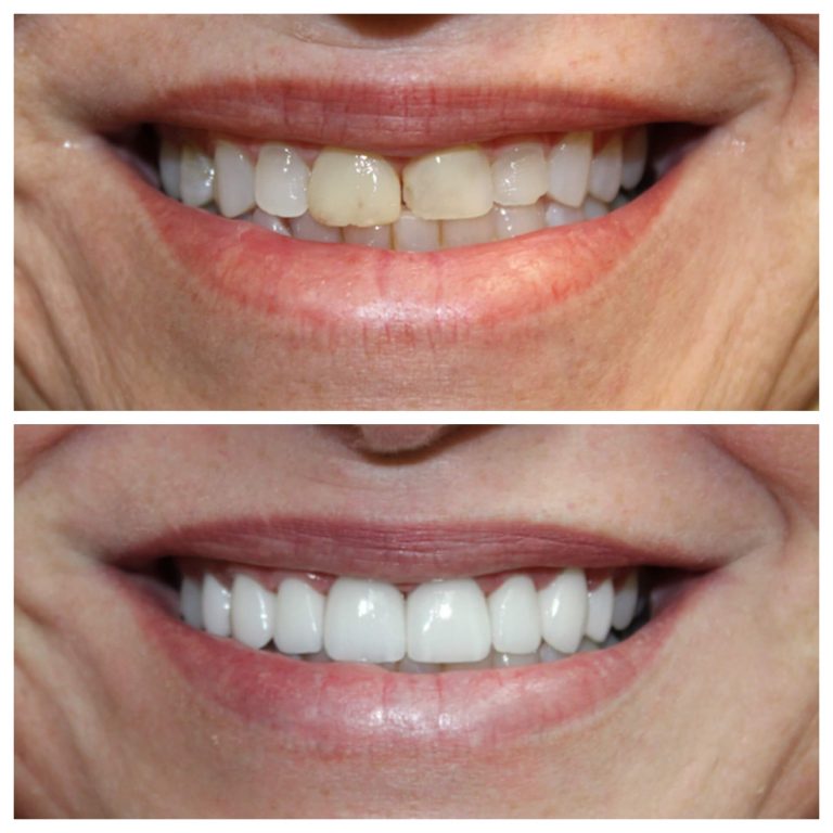 before and after of a veneer patient
