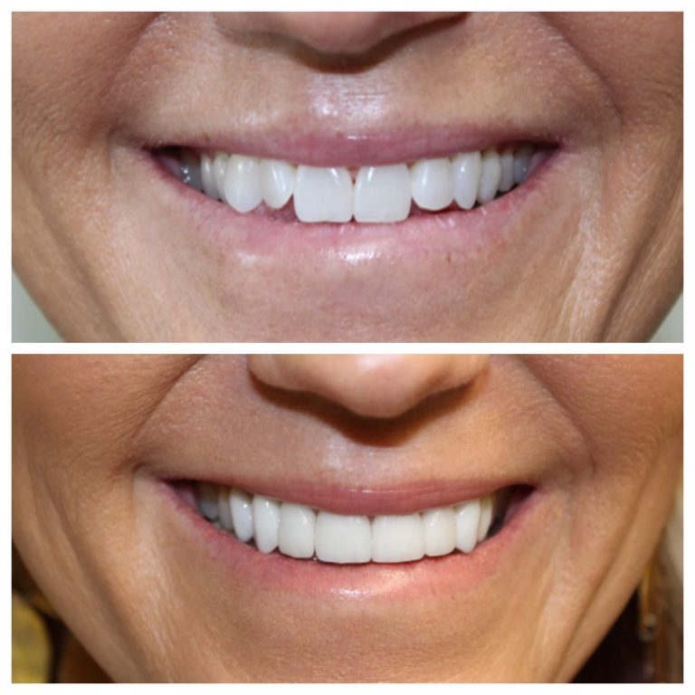 before and after of a veneer patient