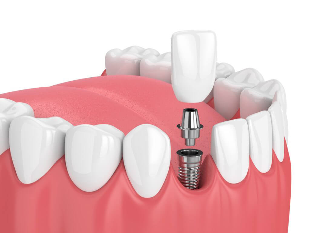 Illustration of a dental implant being placed into a row of teeth