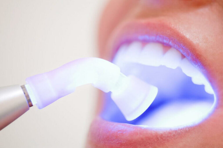 An open mouth with a dental laser being shown inside during a laser dentistry procedure