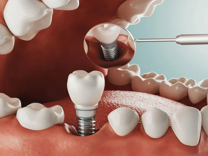 Dental implants in Birmingham, AL at Hall Dental.