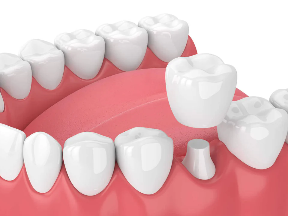 Dental crowns and bridges in Birmingham, AL at Hall Dental.