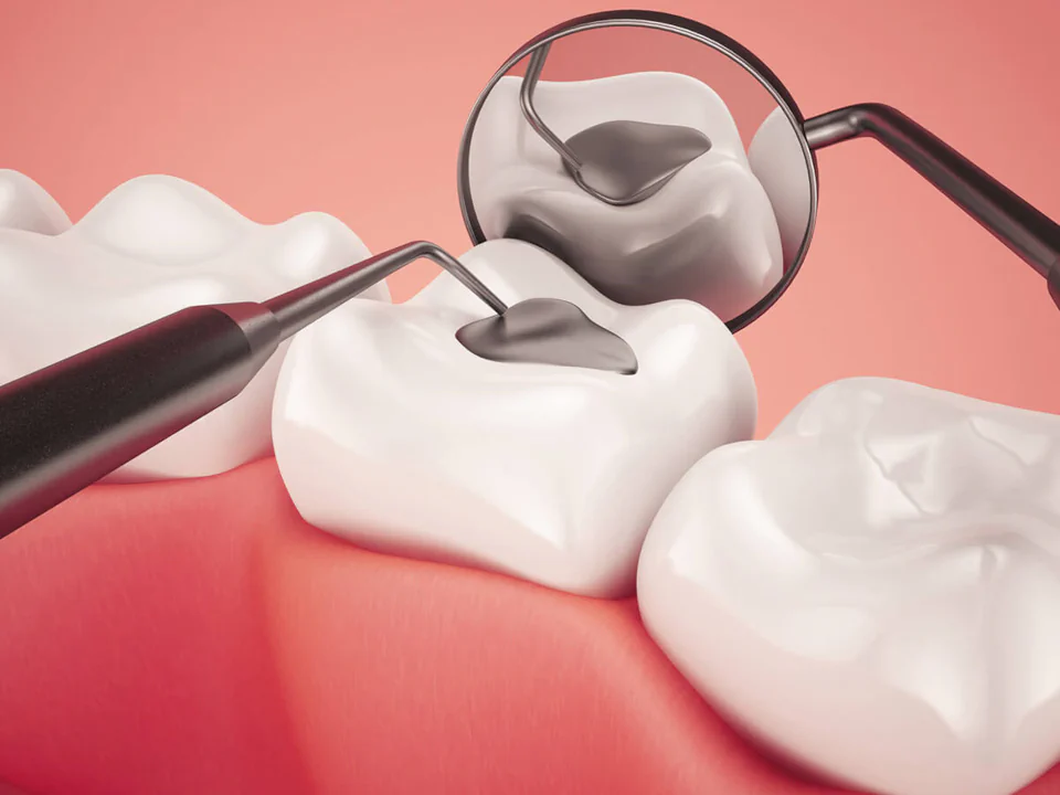 Dental fillings and sealants in Birmingham, AL at Hall Dental.