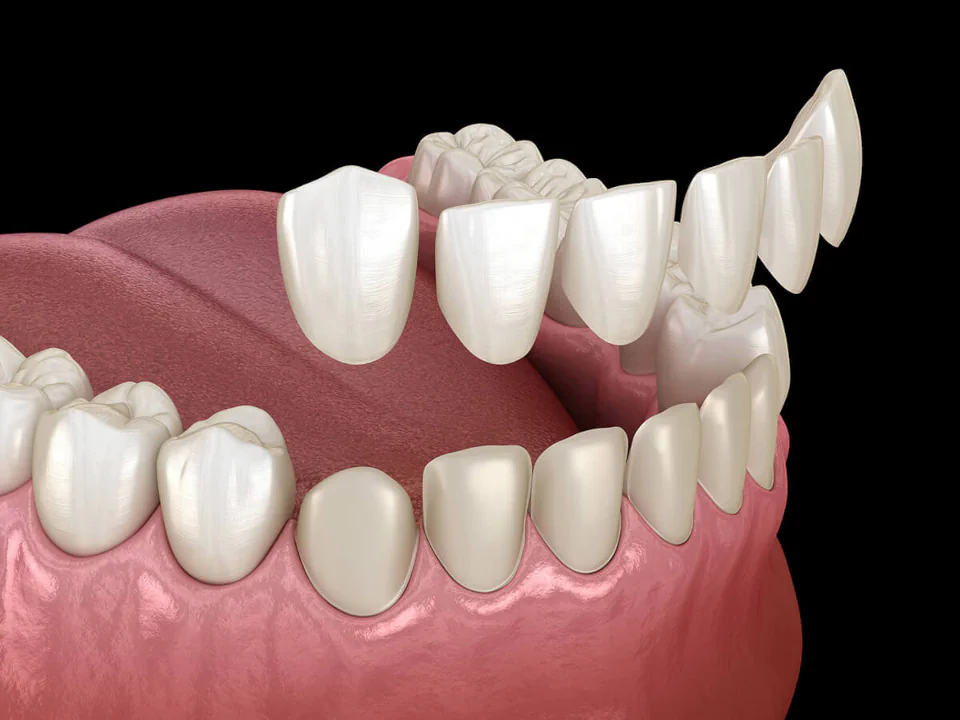 Dental veneers in Birmingham, AL at Hall Dental.