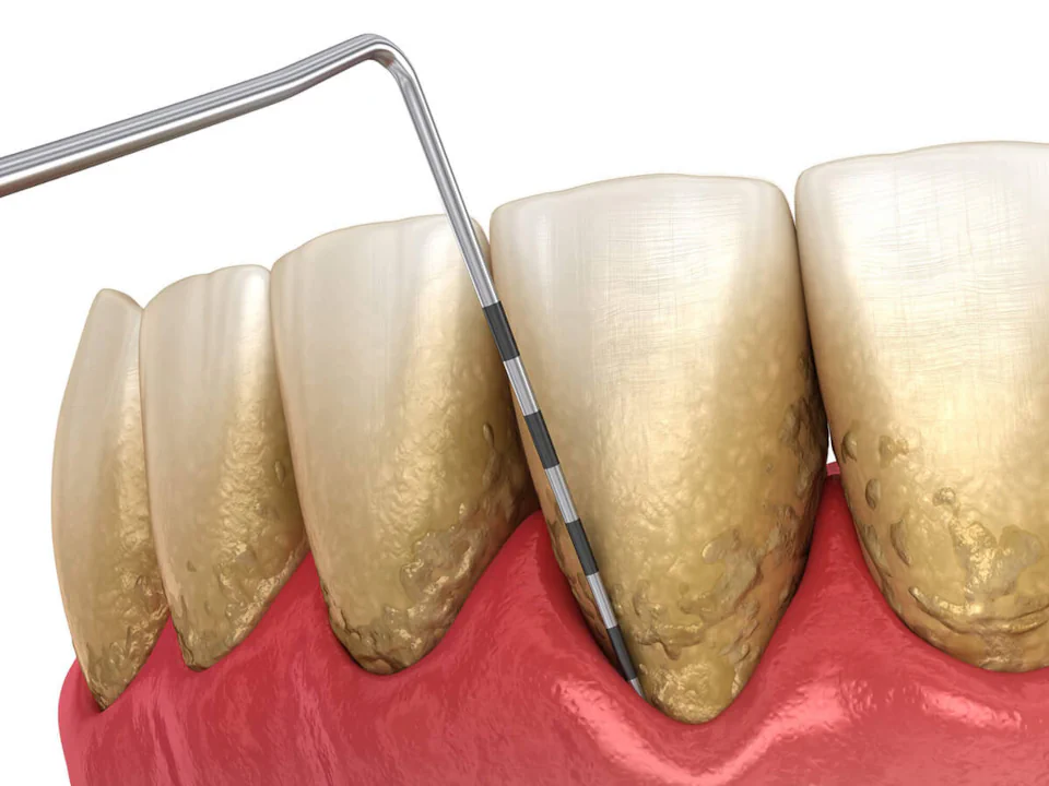 Periodontal disease treatment in Birmingham, AL at Hall Dental.