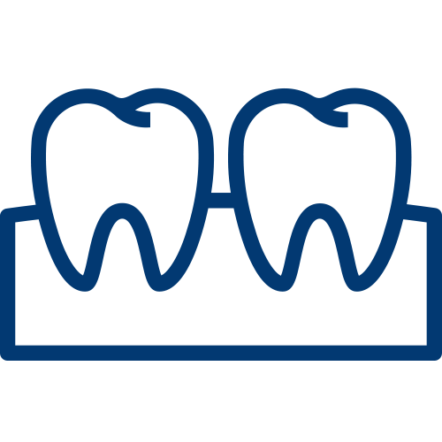 Dental Inlays and Onlays