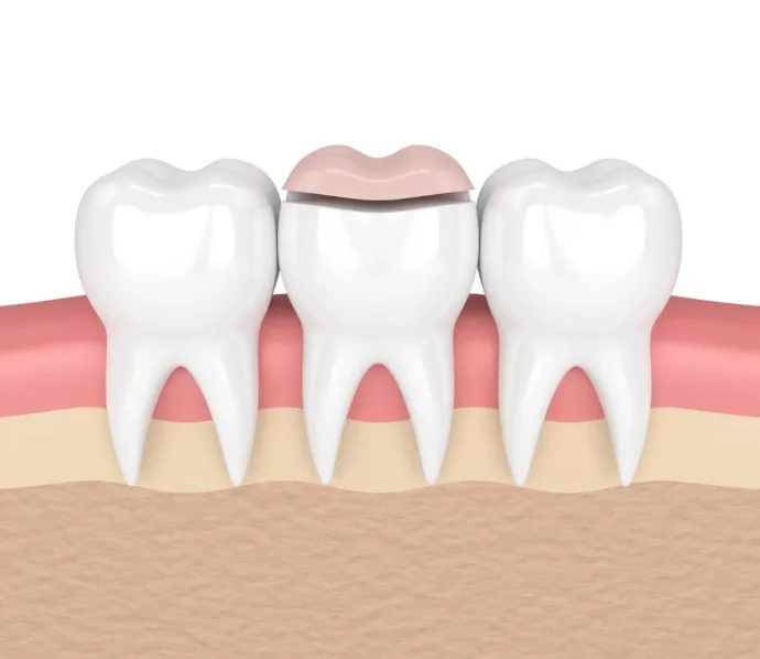Dental inlays and onlays in Birmingham, AL at Hall Dental.