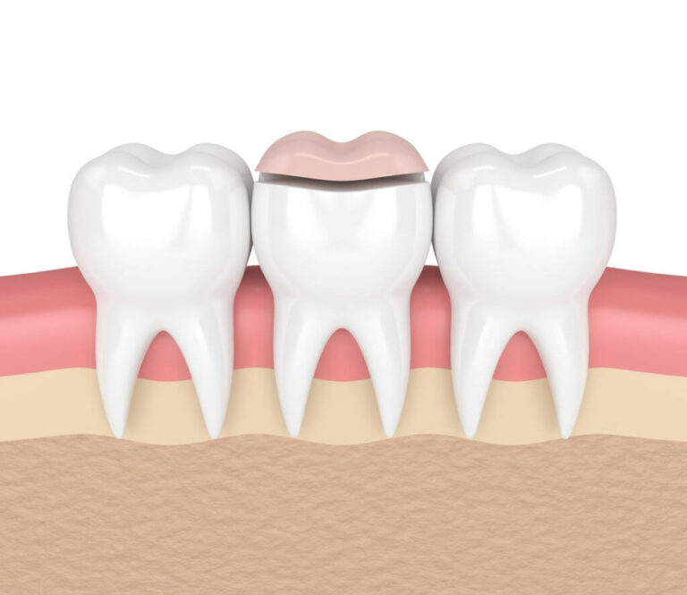 Dental Inlays and Onlays Hall Cosmetic & Family Dentistry