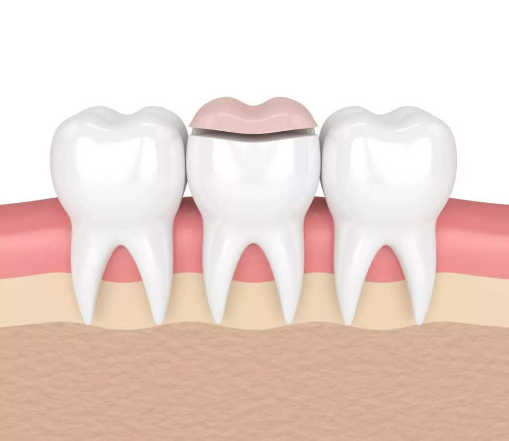 Illustration of a row of three teeth with a dental inlay over the middle tooth