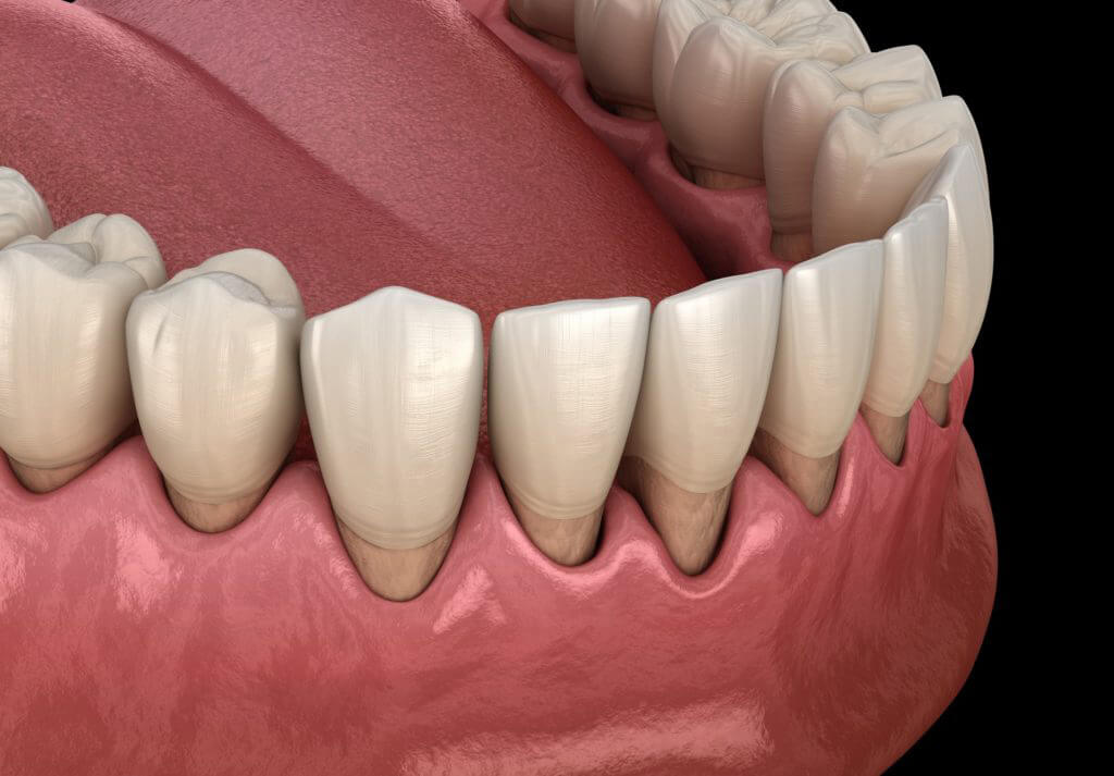 Illustration of a bottom row of teeth showing signs of periodontal/gum disease with the gum line receding