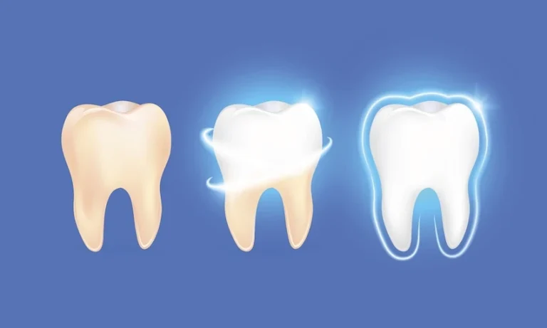 Is Professional Teeth Whitening More Effective Than Over-the-Counter Options?